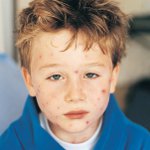 ריכוז contagiosum בילדים ריכוז contagiosum בילדים