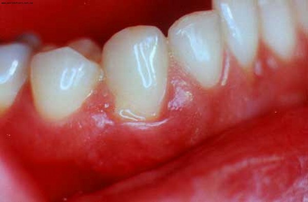 למה גירוד השיניים אצל מבוגר